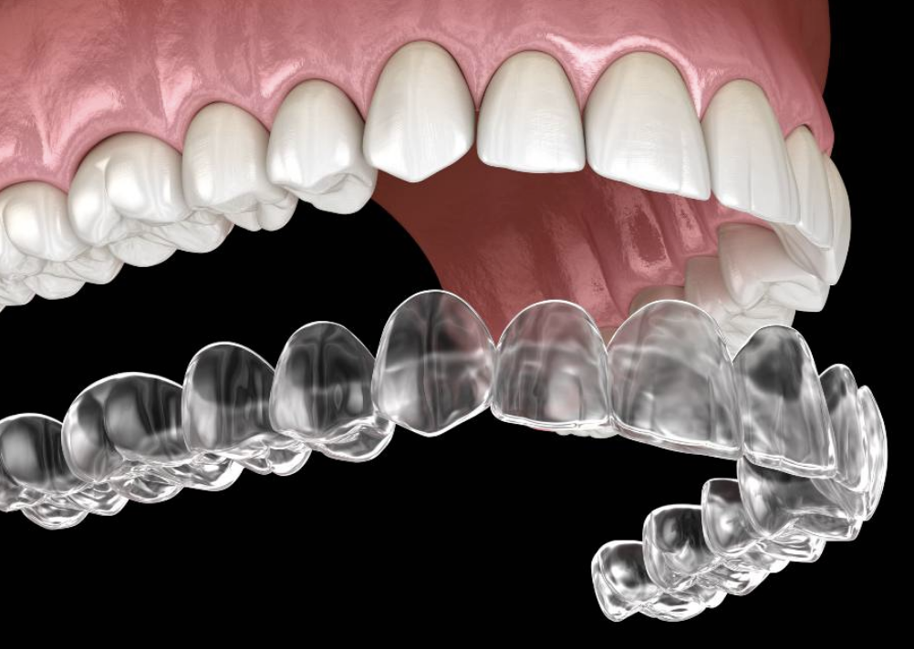 Invisalign Clear Aligners