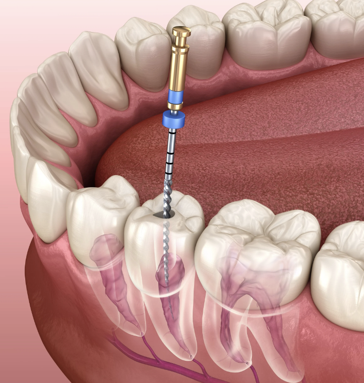 Root Canal