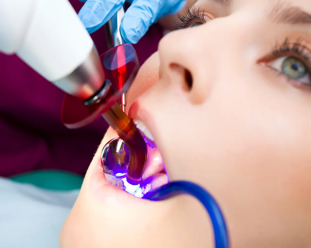 Dental Bonding Thornhill — Single-Visit Smile Corrections That Look Natural