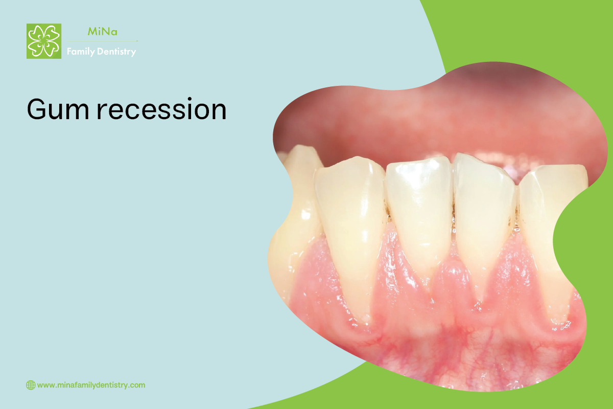 Illustration of gum recession and exposed tooth root — treated at MiNa Family Dentistry