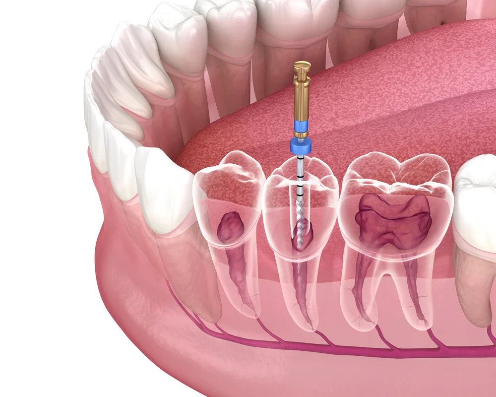 Root canal therapy performed at MiNa Family Dentistry Thornhill Ontario