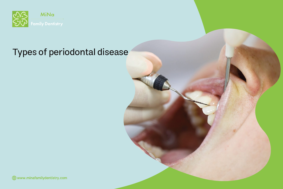 Chart showing the different types and stages of periodontal disease