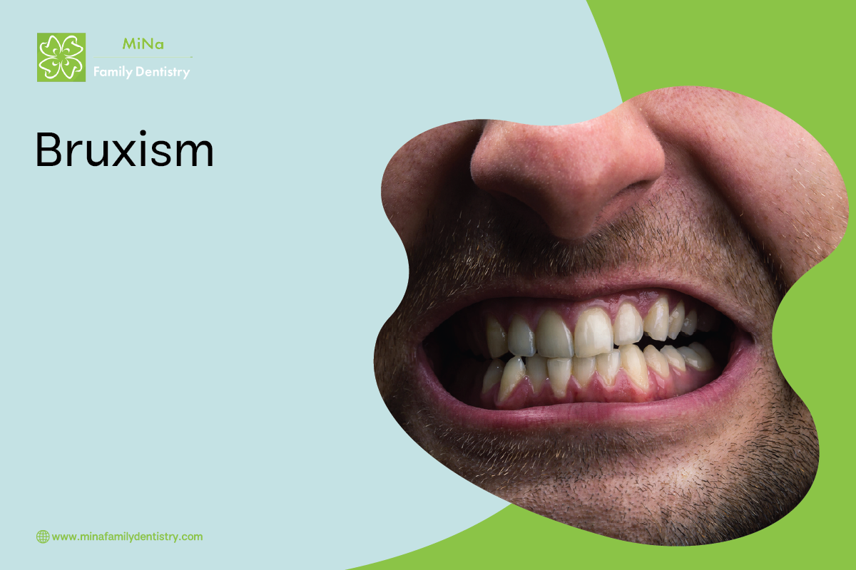Diagram showing the effects of bruxism (teeth grinding) on tooth enamel