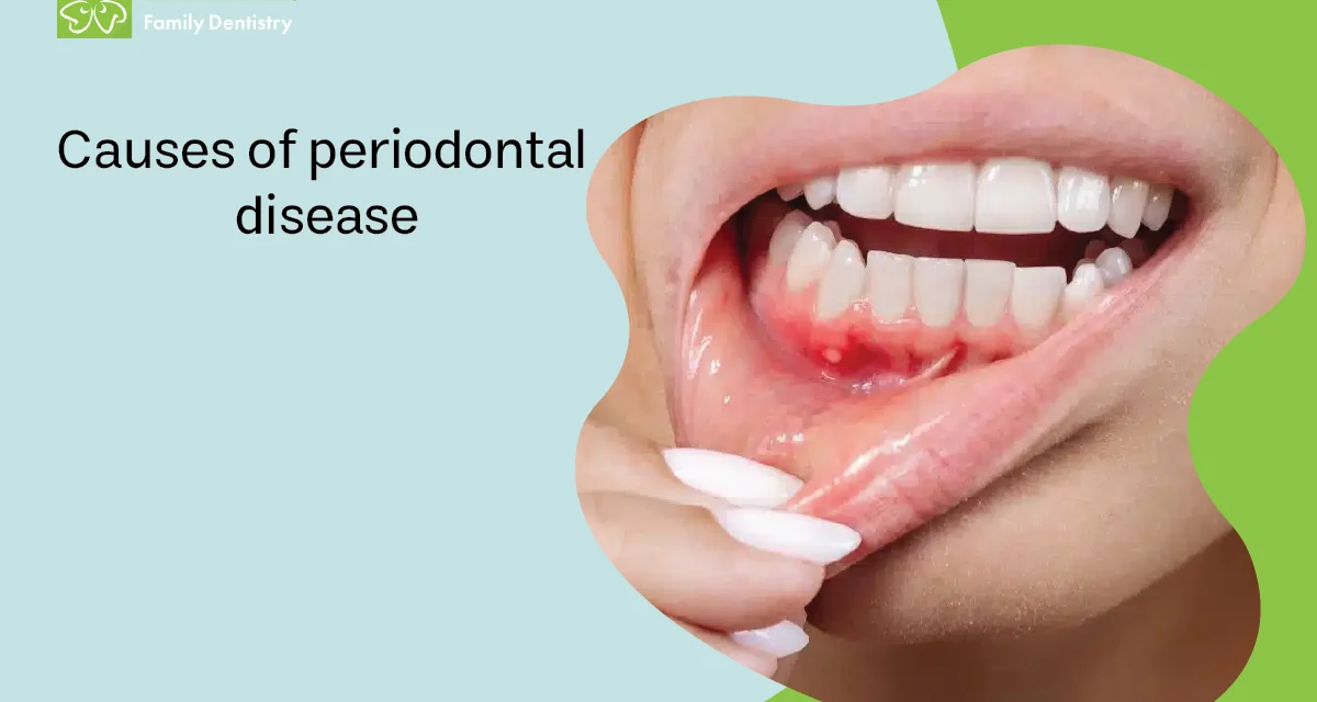 Causes of Periodontal Disease