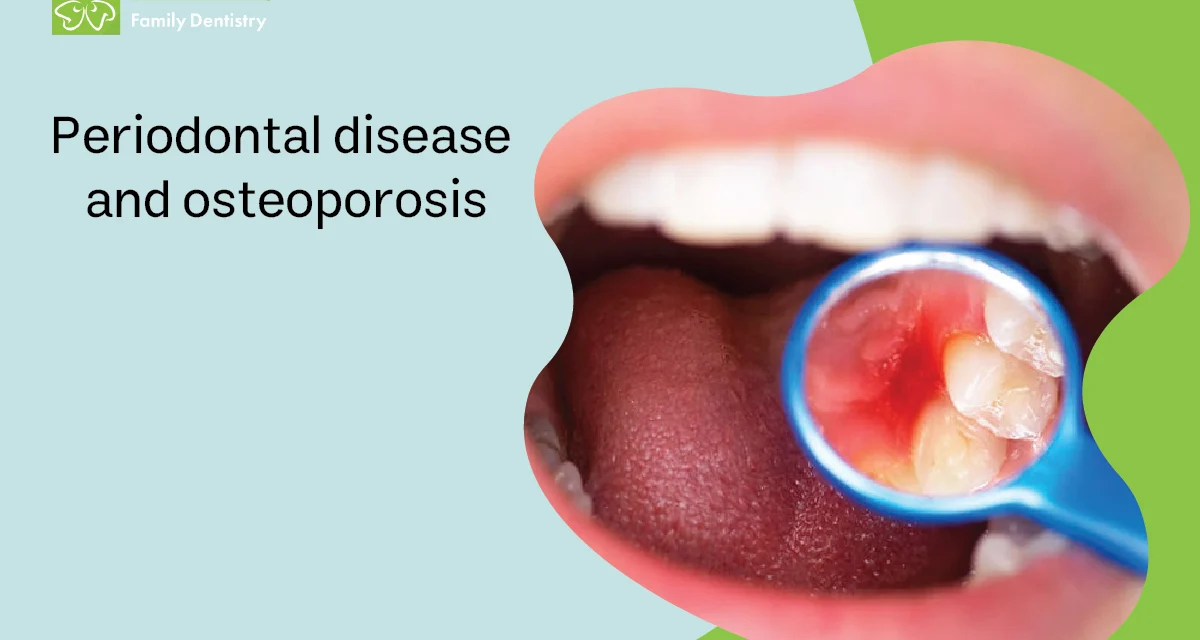 Periodontal Disease and Osteoporosis