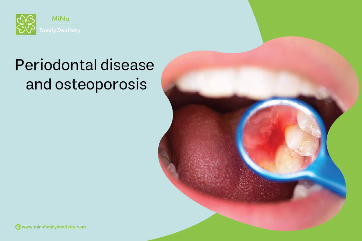Connection between periodontal bone loss and osteoporosis