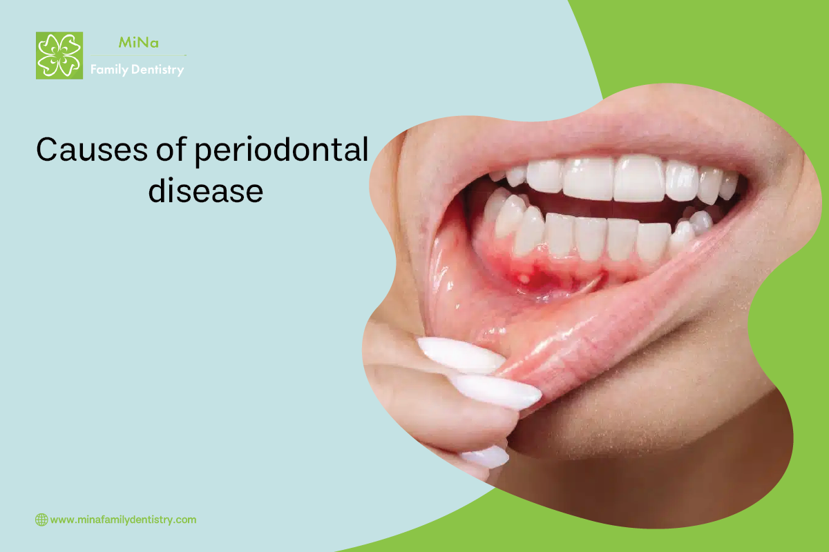 Diagram illustrating the causes and stages of periodontal disease