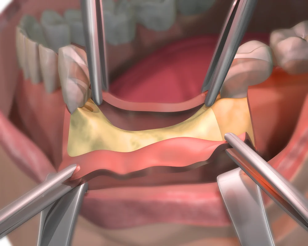Oral surgery including bone grafting and wisdom teeth removal at MiNa Family Dentistry