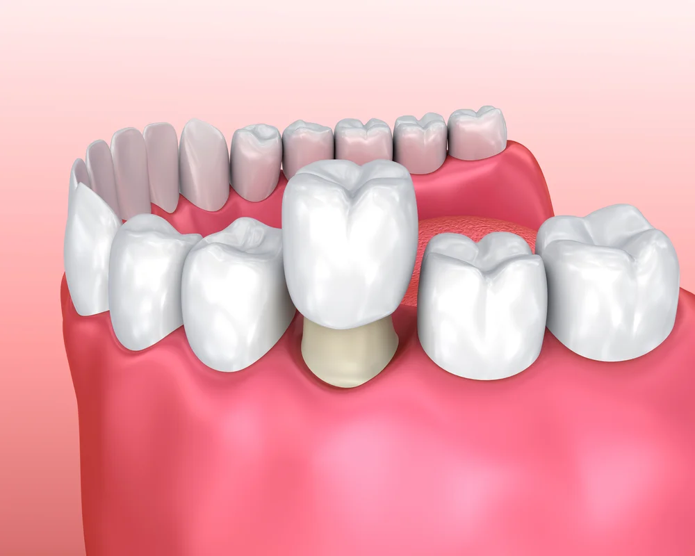 Dental Crown Thornhill: Full-Coverage Tooth Restoration at MiNa Family Dentistry