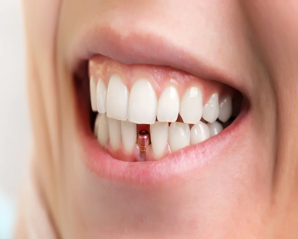 Dental implant consultation with Dr. Mehdi Adibrad at MiNa Family Dentistry, Thornhill