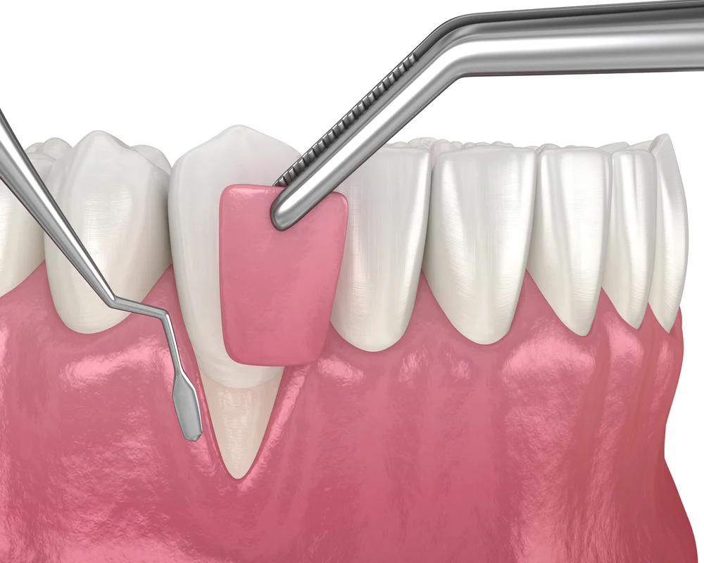 Gum Grafting in Thornhill: Restore Your Gumline and Protect Your Teeth