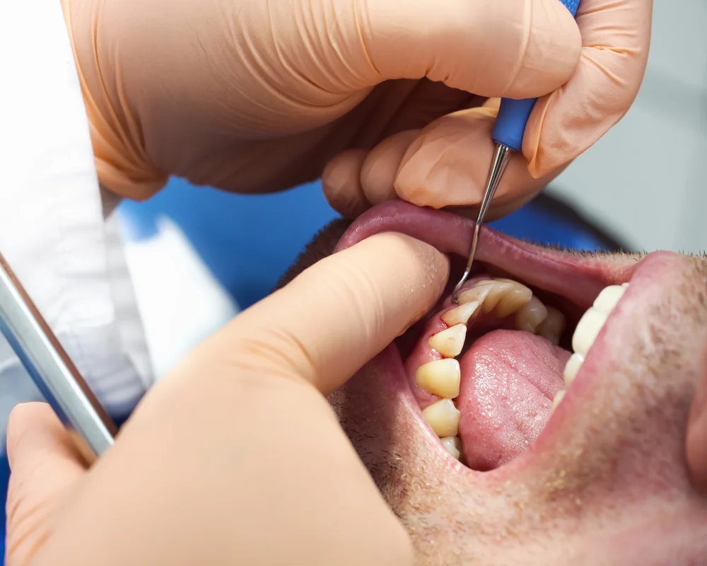 Periodontal gum disease treatment by specialist Dr. Mehdi Adibrad at MiNa Family Dentistry
