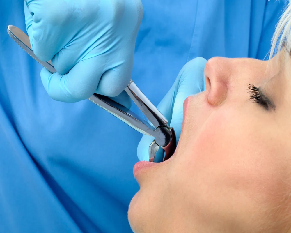 Simple tooth extraction procedure at MiNa Family Dentistry Thornhill