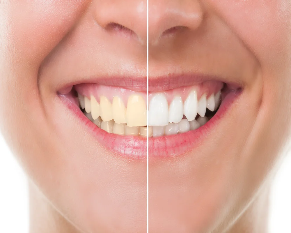 Zoom professional teeth whitening treatment at MiNa Family Dentistry in Thornhill