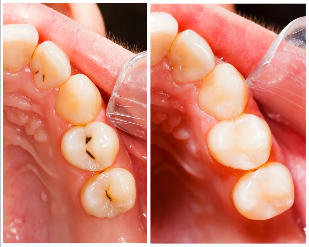 Tooth-Coloured Fillings Thornhill: Mercury-Free Composite Restorations at MiNa Family Dentistry