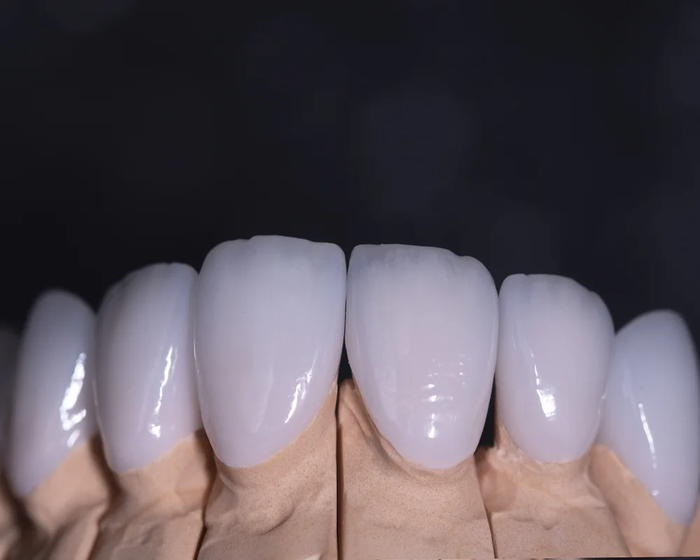 Porcelain veneers smile makeover transformation at MiNa Family Dentistry Thornhill