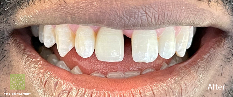 Dental Implants Dental Implants