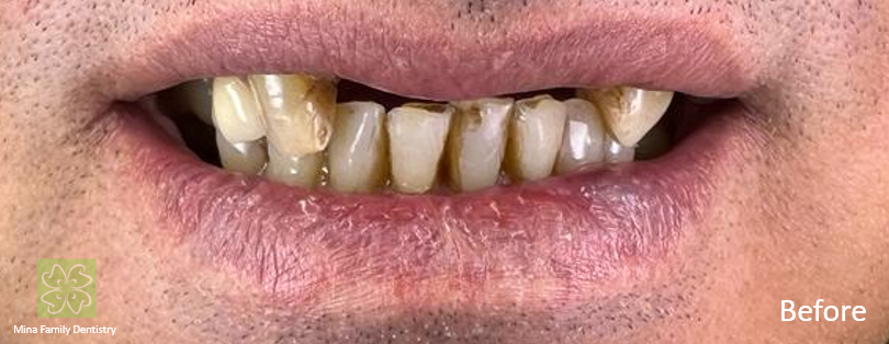 Dental Implants Dental Implants