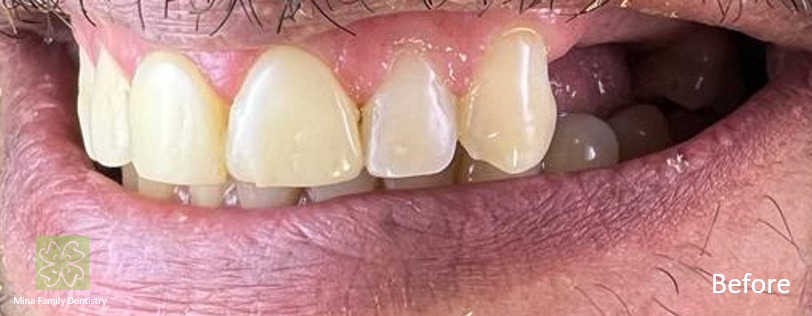 Dental Implants Dental Implants
