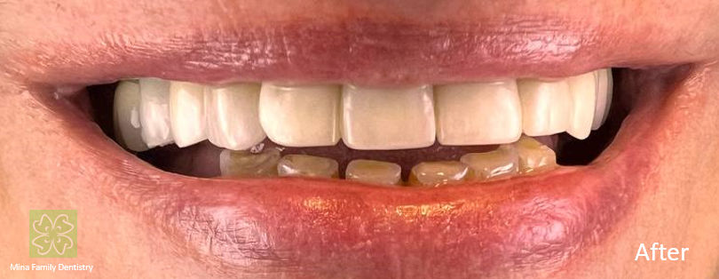 Dental Implants Dental Implants