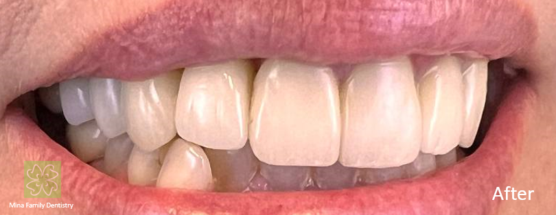 Dental Implants Dental Implants