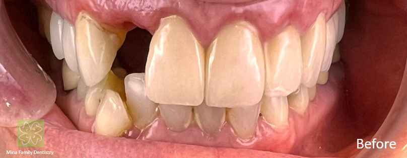 Dental Implants Dental Implants