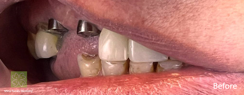 Dental Implants Dental Implants