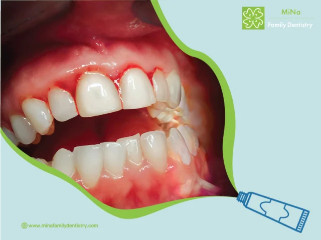 Periodontal treatment result at MiNa Family Dentistry, Thornhill