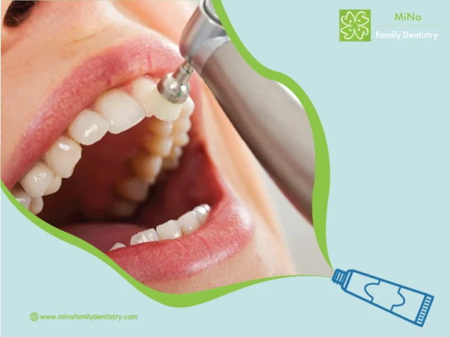 Dental cleaning result at MiNa Family Dentistry, Thornhill