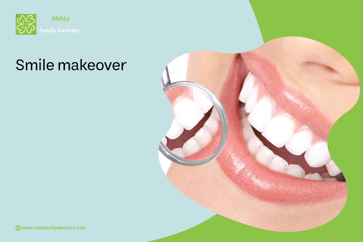 Smile makeover at MiNa Family Dentistry Thornhill — porcelain veneers, whitening, and bonding results