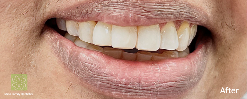 Composite veneers in Thornhill Composite veneers in Thornhill