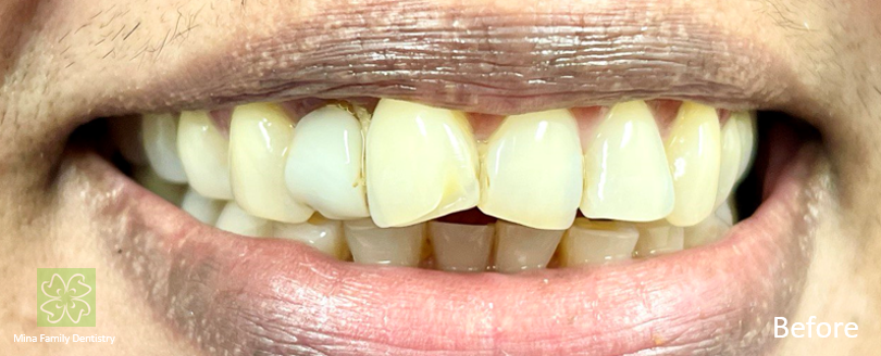 Composite veneers in Thornhill Composite veneers in Thornhill