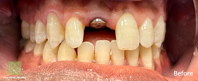 Dental Implants in Thornhill Dental Implants in Thornhill