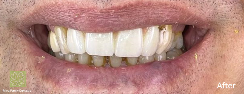 Dental Implants in Thornhill Dental Implants in Thornhill