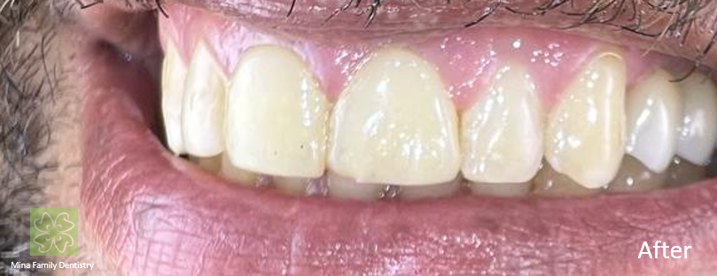 Dental Implants in Thornhill Dental Implants in Thornhill