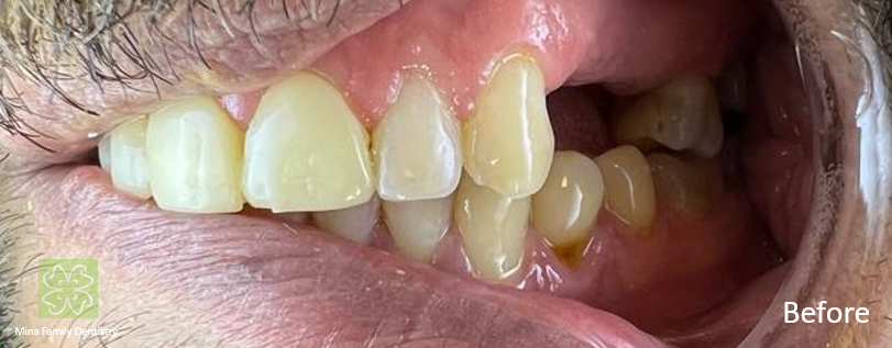 Dental Implants in Thornhill Dental Implants in Thornhill