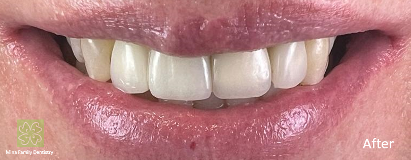 Dental Implants in Thornhill Dental Implants in Thornhill