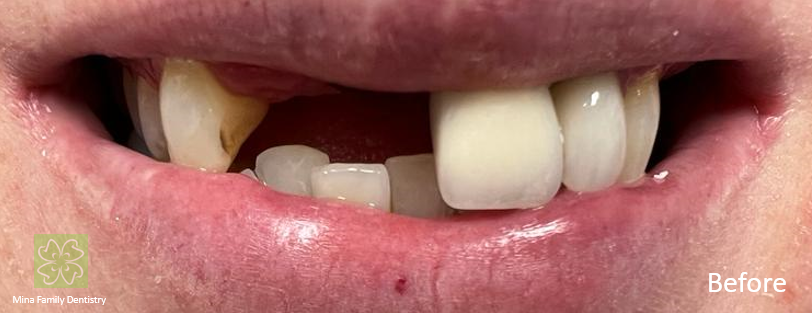Dental Implants in Thornhill Dental Implants in Thornhill