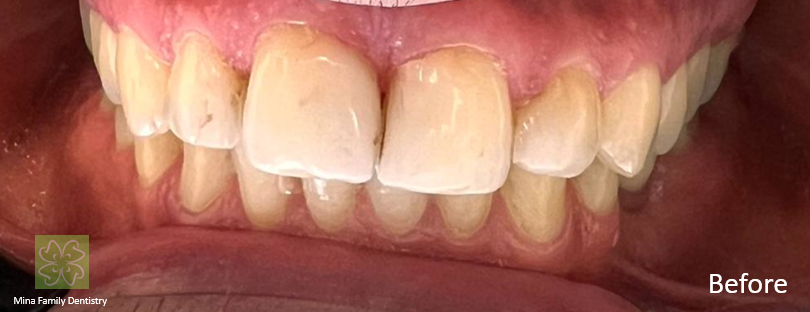 Composite veneers in Thornhill Composite veneers in Thornhill