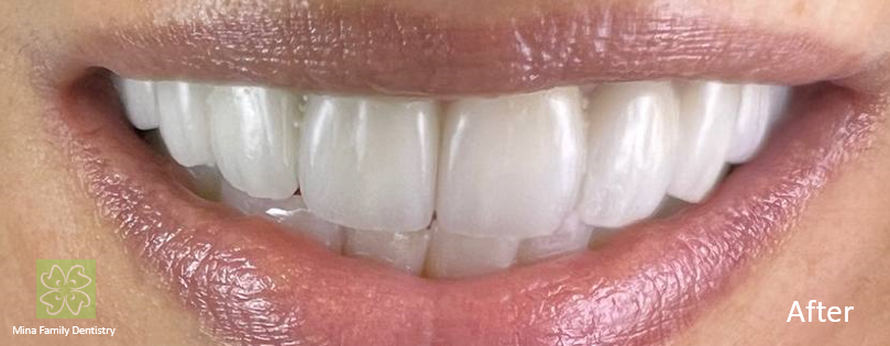 Composite veneers in Thornhill Composite veneers in Thornhill