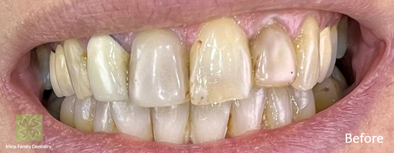 Composite veneers in Thornhill Composite veneers in Thornhill