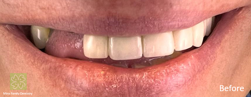 Dental Implants in Thornhill Dental Implants in Thornhill