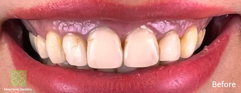 Composite veneers in Thornhill Composite veneers in Thornhill