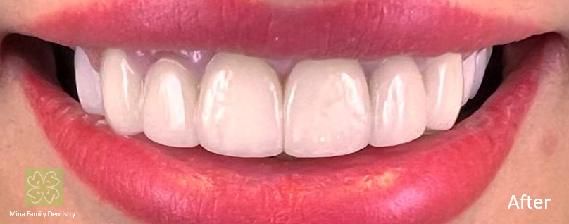Composite veneers in Thornhill Composite veneers in Thornhill