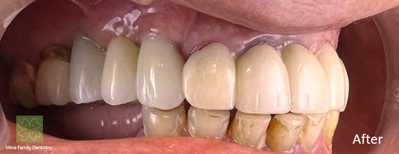 Dental Implants Thornhill Dental Implants Thornhill