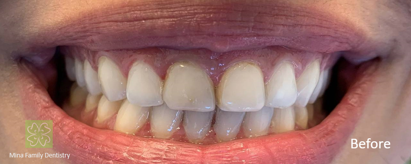 Composite veneers in Thornhill Composite veneers in Thornhill