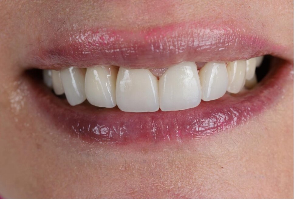 After: bright, uniform smile with implant and laminate veneers