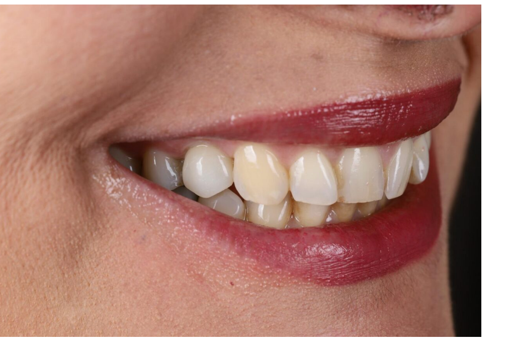After: natural-looking implant crown restoring the smile